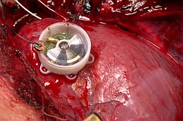 Photo of implanted batteryless pacemaker